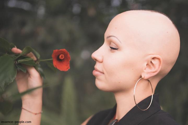 "Alopecia Doesn’t Kill the Person, but It Kills the Self-Confidence". A Hair-Loss Story by Ieva Putnina.